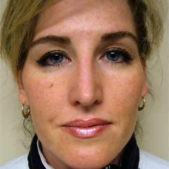 35-44 year old woman treated with Rhinoplasty after 3320865