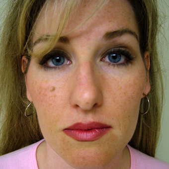 35-44 year old woman treated with Rhinoplasty before 3320865