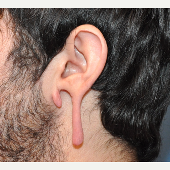 Stretched ("gauged") and Torn Earlobe Repair before 3732904