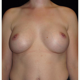 33 year old woman treated with Breast Augmentation after 3093670
