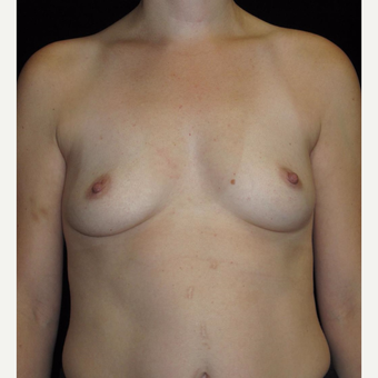 33 year old woman treated with Breast Augmentation before 3093670