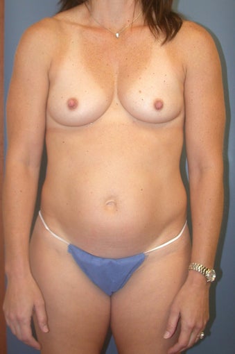 42 year old Mom of 3 Mommy Makeover before 1363165