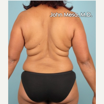 35-44 year old woman treated with Liposuction of flanks, back and sacrum before 3659834