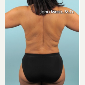 35-44 year old woman treated with Liposuction of flanks, back and sacrum after 3659834