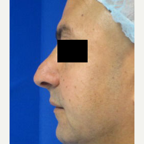 Rhinoplasty before 2994567