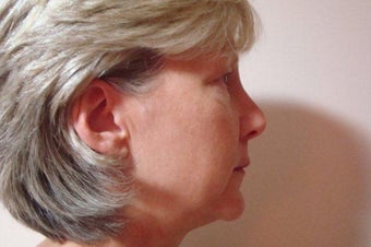 52 Year Old Female MACS Short Scar Mini Facelift & Upper Blepharoplasty Patient 1208883