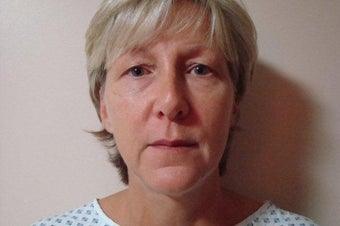 52 Year Old Female MACS Short Scar Mini Facelift & Upper Blepharoplasty Patient before 1208883