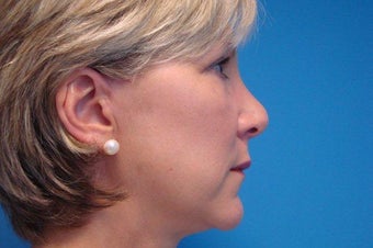 52 Year Old Female MACS Short Scar Mini Facelift & Upper Blepharoplasty Patient 1208883