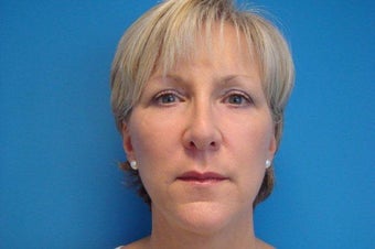 52 Year Old Female MACS Short Scar Mini Facelift & Upper Blepharoplasty Patient after 1208883