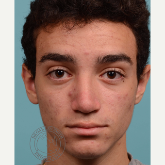 17 or under year old man treated with Septoplasty/open rhinoplasty after 3108905