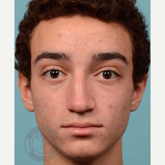 17 or under year old man treated with Septoplasty/open rhinoplasty before 3108905