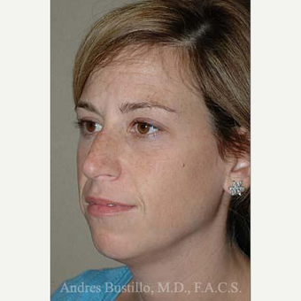 35 year old woman treated with Rhinoplasty before 3462371