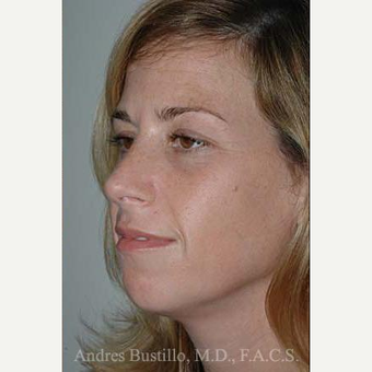 35 year old woman treated with Rhinoplasty after 3462371