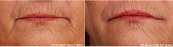 A woman in her 60s has smoker's lines treated with Belotero before 1035716