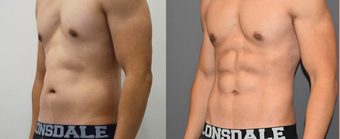 25-34 year old man treated with Vaser Liposuction before 4599292