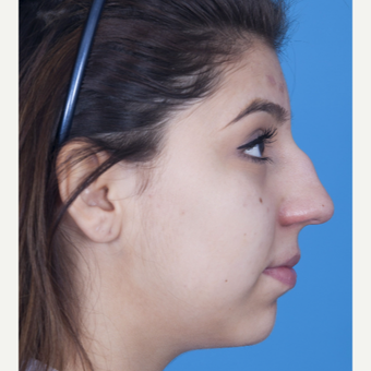 17 or under year old woman treated with Rhinoplasty before 3115269