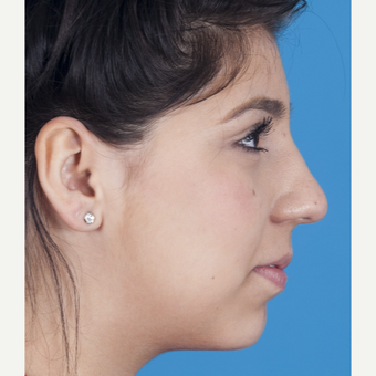 17 or under year old woman treated with Rhinoplasty after 3115269