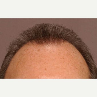 45-54 year old man treated with Hair Transplant after 1647697