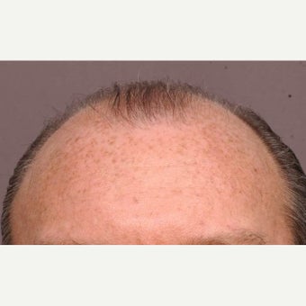 45-54 year old man treated with Hair Transplant before 1647697
