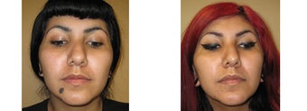 Mole Removal photos before 951885