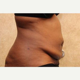Tummy Tuck with Liposuction before 3454626
