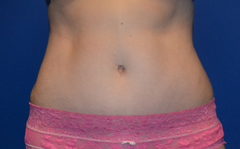 32 Year Old Woman Before and After Abdominoplasty/Tummy Tuck and Liposuction after 1520694
