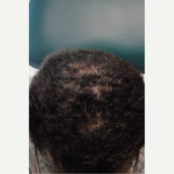 45-54 year old woman treated with PRP for Hair Loss before 3195501