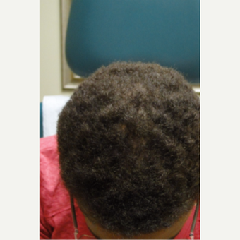 45-54 year old woman treated with PRP for Hair Loss after 3195501