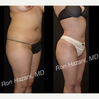 18-24 year old woman treated with Brazilian Butt Lift before 3680286