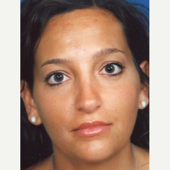 18-24 year old woman treated with Rhinoplasty after 2266607