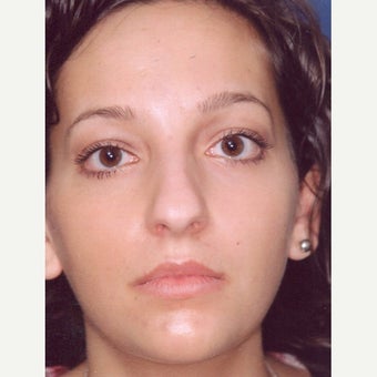 18-24 year old woman treated with Rhinoplasty before 2266607