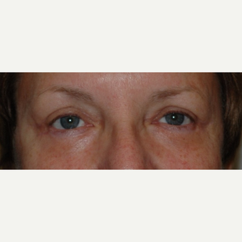 Eyelid Surgery after 3346348