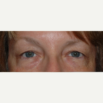 Eyelid Surgery before 3346348