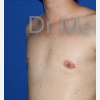 18-24 year old man treated with FTM Chest Masculinization Surgery after 3828941