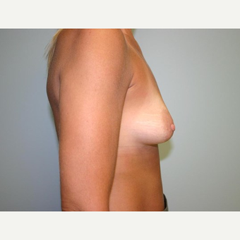 Breast Augmentation before 3444127