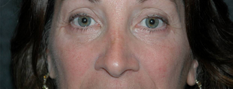 Eye Bags Treatment: Using your own fat to fill in the under eye hollows after 1011270