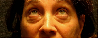 Eye Bags Treatment: Using your own fat to fill in the under eye hollows before 1011270