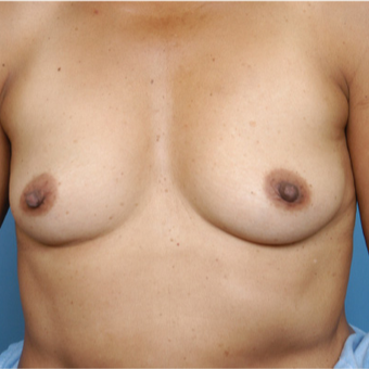 45-54 year old woman treated with Breast Implants before 3387804