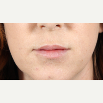 25-34 year old woman treated with Lip Augmentation after 3724599