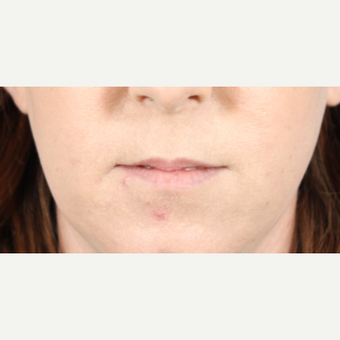 25-34 year old woman treated with Lip Augmentation before 3724599