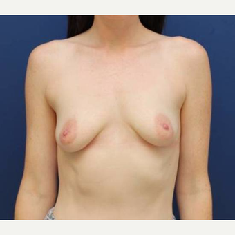27 year old female, 350cc silicone gel Mentor high profile breast implants, submuscular before 2998815