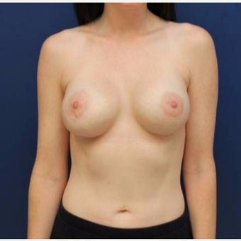 27 year old female, 350cc silicone gel Mentor high profile breast implants, submuscular after 2998815