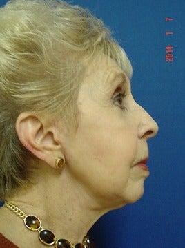 75 and up year old woman treated for Facelift 1534884