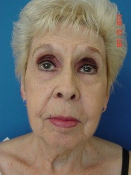 75 and up year old woman treated for Facelift before 1534884