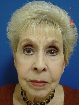 75 and up year old woman treated for Facelift after 1534884