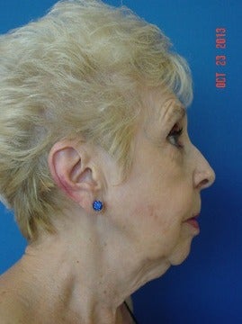 75 and up year old woman treated for Facelift 1534884