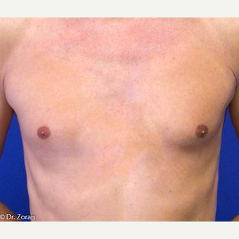 35-44 year old man treated with Pec Implants before 3093282