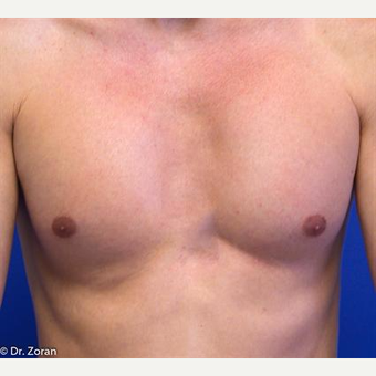 35-44 year old man treated with Pec Implants after 3093282