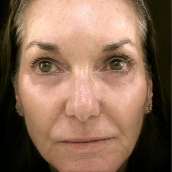 55-64 year old woman treated with Eyelid Surgery after 3490075