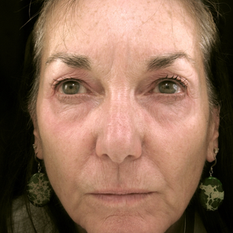 55-64 year old woman treated with Eyelid Surgery before 3490075